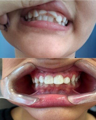 Antes e depois de tratamento odontológico