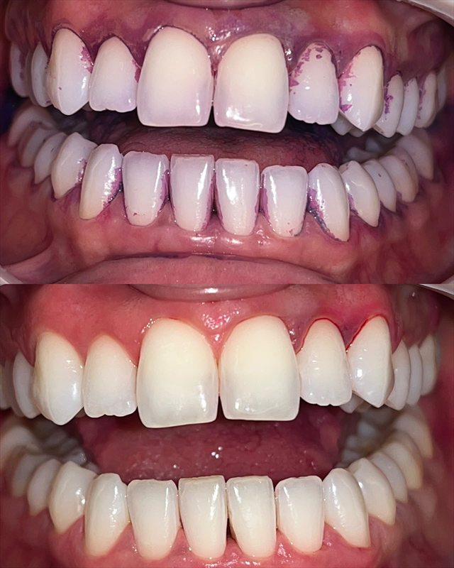 Antes e depois de tratamento estético dos dentes
